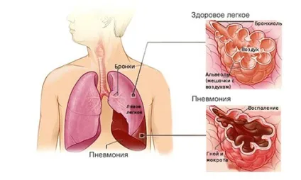 Не можу відкашлятися що робити хворому в подібній ситуації (можу) Не можу відкашлятися що робити хворому в подібній ситуації