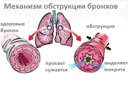 Як лікувати застарілий бронхіт (перший по бронхіту) Як лікувати застарілий бронхіт
