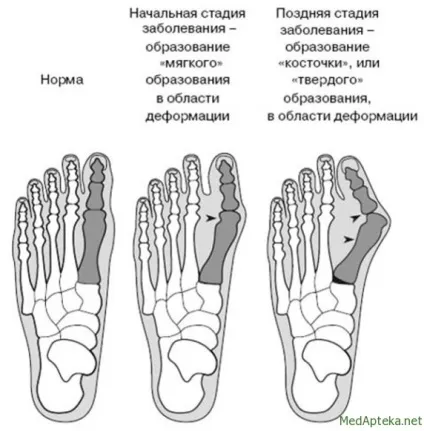 Як проявляється подагра симптоми, відгуки (проявляється) Як проявляється подагра симптоми, відгуки