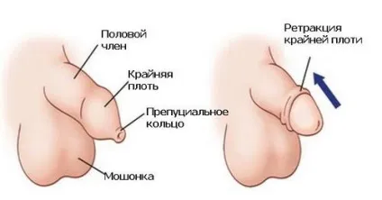 Обрізання крайньої плоті у чоловіків як робиться і як виглядає (крайній) Обрізання крайньої плоті у чоловіків як робиться і як виглядає