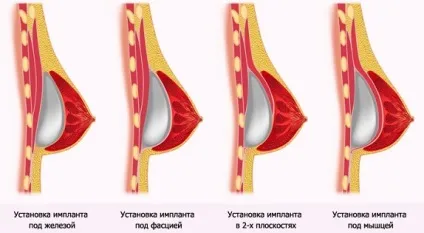 Чи потрібно міняти імпланти молочних залоз і що може бути причиною (залоз) Чи потрібно міняти імпланти молочних залоз і що може бути причиною