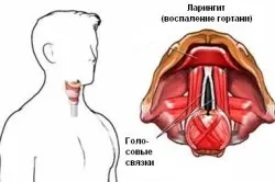 Як повернути голос при ларингіті (повернути) Як повернути голос при ларингіті
