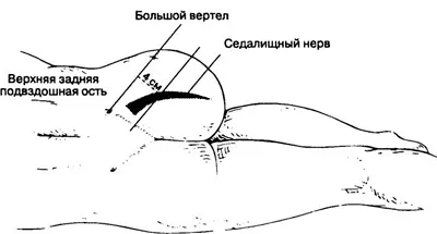 Як виконується блокада сідничного нерва (сідничного) Як виконується блокада сідничного нерва