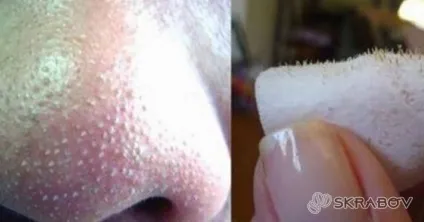 Як видавити чорні крапки на носі як правильно тиснути (відео), видавлювання, skrabov (тиснути) Як видавити чорні крапки на носі як правильно тиснути (відео), видавлювання, skrabov