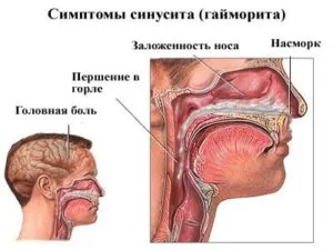 Катаральний синусит що це таке, симптоми і лікування