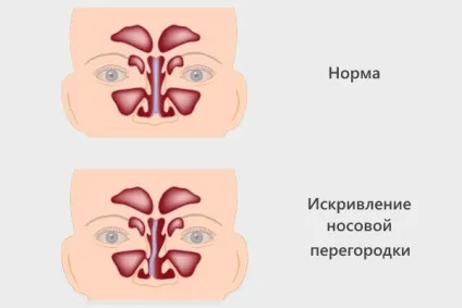 Катаральний синусит симптоми, лікування і діагностика