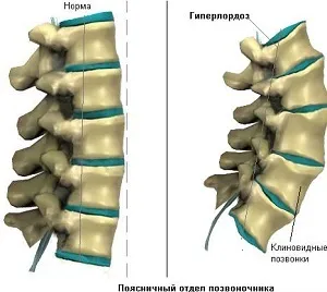 Клиновидні хребці (напівхребці) у дорослих і дітей причини і лікування (дорослих) Клиновидні хребці (напівхребці) у дорослих і дітей причини і лікування