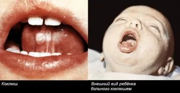 Коклюш дитяча інфекція і боротьба з нею (з розвитком захворювання) Коклюш дитяча інфекція і боротьба з нею