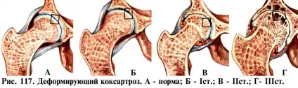 Коксартроз види, симптоми, лікування і профілактика