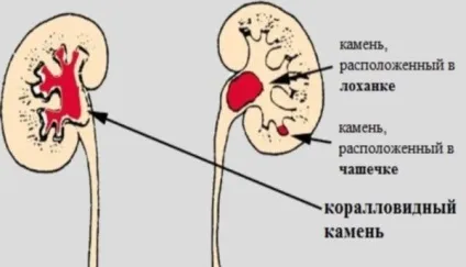 Коралоподібні камені в нирках симптоми, діагностика, лікування народними методами і дієтою (операція з видалення коралловидного каменю з нирки) Коралоподібні камені в нирках симптоми, діагностика, лікування народними методами і дієтою