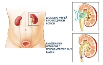 Коралоподібні камені в нирках симптоми, видалення, лікування, дієта (коралоподібні камені в нирках видалення лікування народними засобами дієта) Коралоподібні камені в нирках симптоми, видалення, лікування, дієта