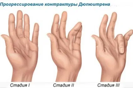 контрактура Дюпюітрена