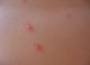 шкірні висипання