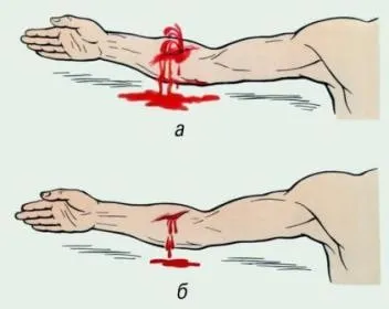 Кровотечі і способи їх зупинки (зупинки) Кровотечі і способи їх зупинки