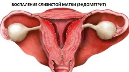 Кров'янисті виділення після місячних причини, норма і патологія, що робити (причини) Кров'янисті виділення після місячних причини, норма і патологія, що робити