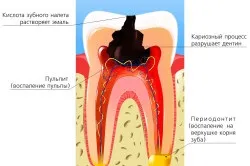 Лікувальна паста при глибокому карієсі (карієсі) Лікувальна паста при глибокому карієсі