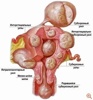Лапароскопія міоми матки