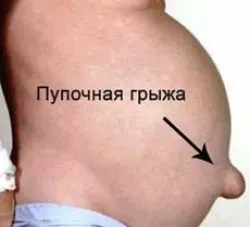 Лікування пупкової грижі