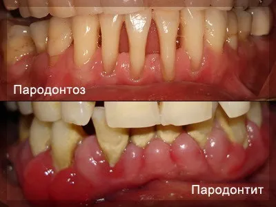 Лікування пародонтозу народними засобами ефірні масла, прополіс (засобами) Лікування пародонтозу народними засобами ефірні масла, прополіс