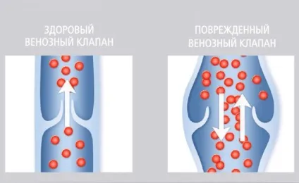 Лікування трофічних виразок нижніх кінцівок препарати для терапії (кінцівок) Лікування трофічних виразок нижніх кінцівок препарати для терапії