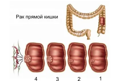 Лікування раку прямої кишки без операції (народна медицина) Лікування раку прямої кишки без операції
