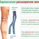 Кращі народні рецепти від варикозу - найефективніші народні засоби (рецепти) Кращі народні рецепти від варикозу - найефективніші народні засоби
