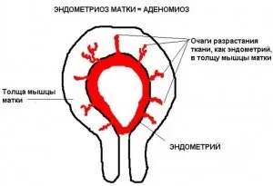 Локальне потовщення міометрія по задній стінці (міометрія) Локальне потовщення міометрія по задній стінці