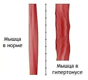 Локальне потовщення міометрія по задній стінці (міометрія) Локальне потовщення міометрія по задній стінці