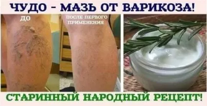 Кращі народні рецепти від варикозу - найефективніші народні засоби (кошти) Кращі народні рецепти від варикозу - найефективніші народні засоби
