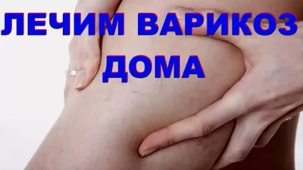 Кращі народні рецепти від варикозу - найефективніші народні засоби (варикозу) Кращі народні рецепти від варикозу - найефективніші народні засоби