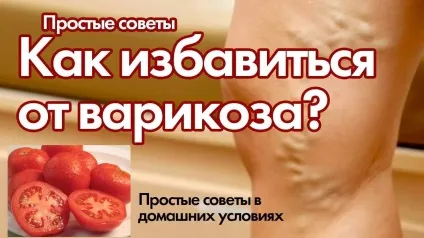 Кращі народні рецепти від варикозу - найефективніші народні засоби (народні) Кращі народні рецепти від варикозу - найефективніші народні засоби