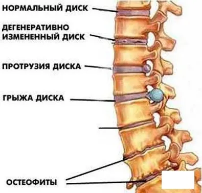 Остеохондроз, лікування та діагностика (хребет) Остеохондроз, лікування та діагностика