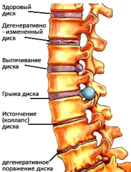 Остеохондроз симптоми, методи діагностики і лікування остеохондрозу (чому остеохондроз) Остеохондроз симптоми, методи діагностики і лікування остеохондрозу