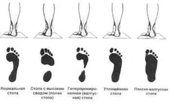 Масаж стоп при плоскостопості види і рекомендації