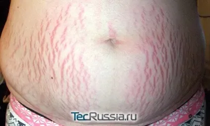 Масло weleda від розтяжок і для їх профілактики, чи підходить для вагітних, фото і відео відгуки (розтяжок) Масло weleda від розтяжок і для їх профілактики, чи підходить для вагітних, фото і відео відгуки