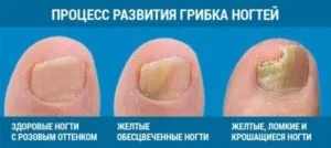 Мазі і креми проти грибка нігтів на ногах (мазі) Мазі і креми проти грибка нігтів на ногах