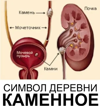 Сечокам'яна хвороба (6) (розвитку сечокам'яної хвороби) Сечокам'яна хвороба (6)
