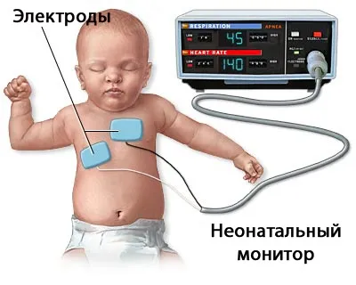 Міокардит у дітей причини, симптоми і його лікування