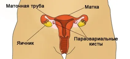 Багатокамерна кіста яєчника (лівого і правого) операція, лікування без операції, чому виникла