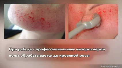 Мезороллер - в чому підступ