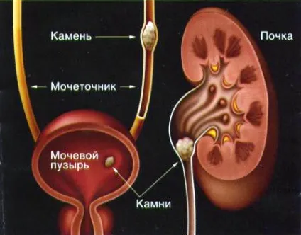 Сечокам'яна хвороба (6) (двоокис кремнію уролитов) Сечокам'яна хвороба (6)