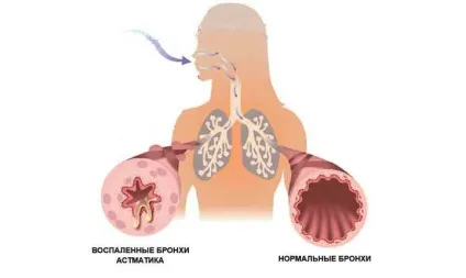 Навантаження на праве передсердя причини і лікування (праве) Навантаження на праве передсердя причини і лікування