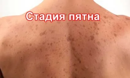 На спині бородавка причини появи, способи лікування, видалення (причини) На спині бородавка причини появи, способи лікування, видалення