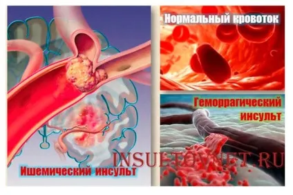 Неврологічні симптоми при інсульті ознаки і їх особливості (неврологічні) Неврологічні симптоми при інсульті ознаки і їх особливості