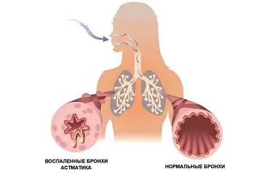 Загострення бронхіальної астми лікування, симптоми і терапія (астми) Загострення бронхіальної астми лікування, симптоми і терапія