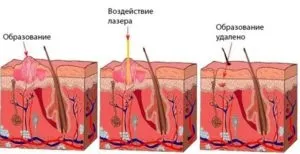 Папіломи на голові - причини, симптоми, лікування (причини) Папіломи на голові - причини, симптоми, лікування