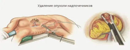 Пухлина наднирників у жінок (розміри) - основні симптоми (жінок) Пухлина наднирників у жінок (розміри) - основні симптоми