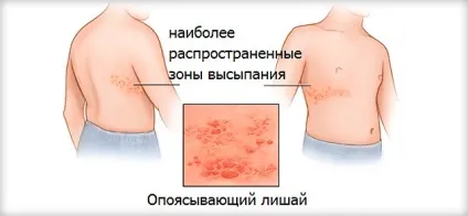 Оперізуючий лишай заразний чи ні у людини, як передається герпес від хворого, профілактика (передається) Оперізуючий лишай заразний чи ні у людини, як передається герпес від хворого, профілактика