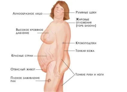 Пухлина наднирників у жінок (розміри) - основні симптоми (жінок) Пухлина наднирників у жінок (розміри) - основні симптоми