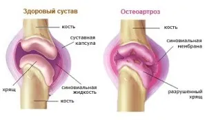 Остеоартроз - причини, симптоми і народні засоби лікування остеоартрозу (народні засоби лікування) Остеоартроз - причини, симптоми і народні засоби лікування остеоартрозу